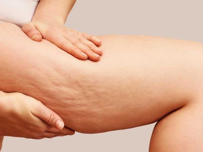 Tratamento nutricional para lipedema em Curitiba
