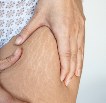 Tratamento Avancado para Celulite